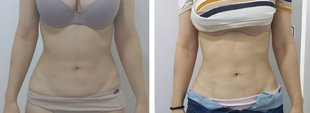 criolipolise antes e depois resultatos mulher